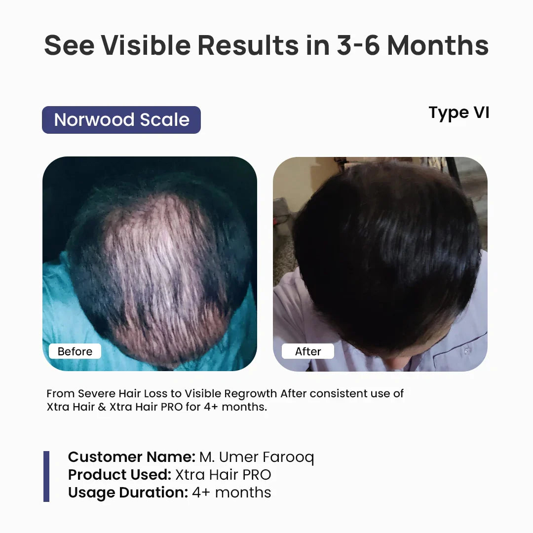 Before and after comparison of hair growth using Xtra Hair PRO, showing a Norwood Scale Type VI person with visible results in 3-6 months.