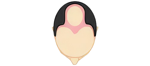 Stage 4 — Extensive