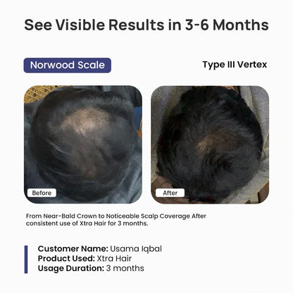 Before and after comparison of scalp coverage with Xtra Hair product, showing visible results in 3-6 months.
